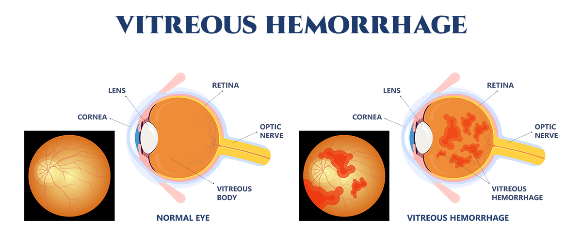 Vitreous Hemorrhage