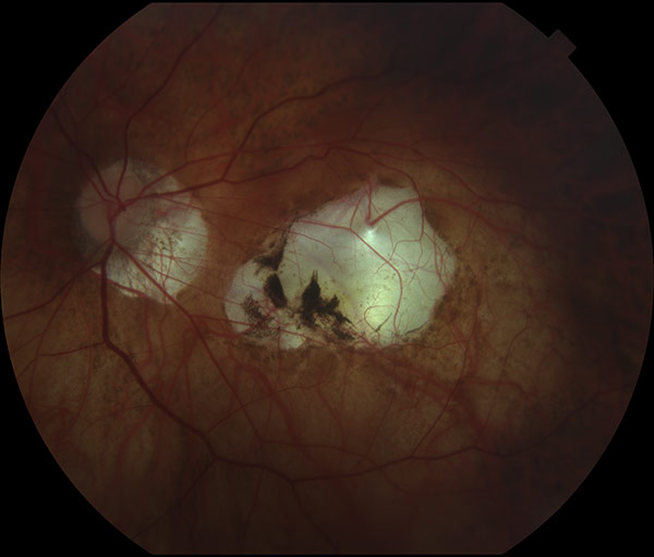 Myopic Degeneration