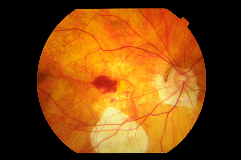 Myopic Degeneration