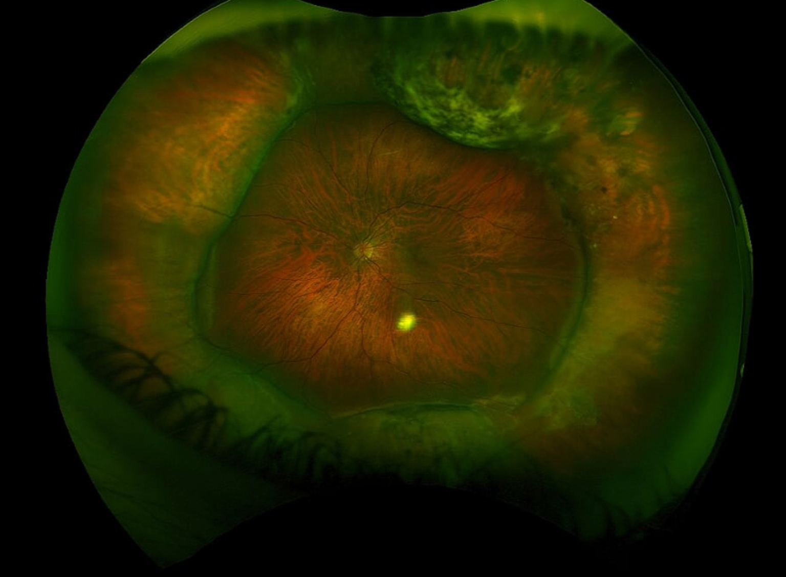 Buckle Effect Scleral Buckle Surgery - Retina Center of San Diego